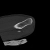SPORK, NICO - 22.03.1976 - 02.08.2022 - CT obere Extremität - 18:02:23